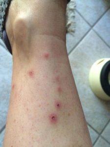 bedbug bites in birmingham