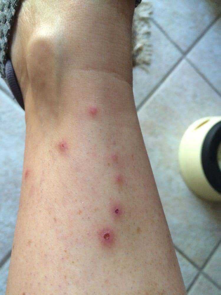 bed bug bites pictures